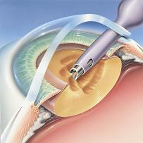 image of surgeon painlessly removing cataract during surgery